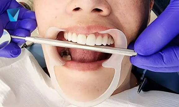 Blanqueamiento dental